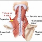 Trigger points